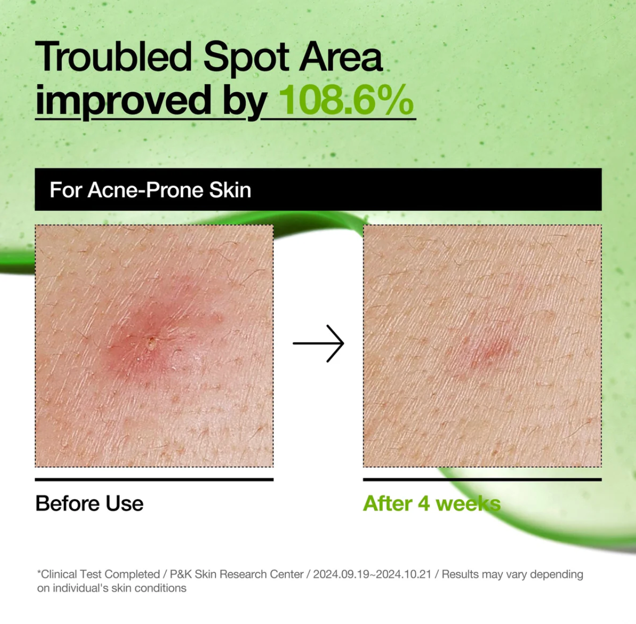 ANUA Azelaic Acid 10% Serum - Serum Anti-rojeces 30 ml